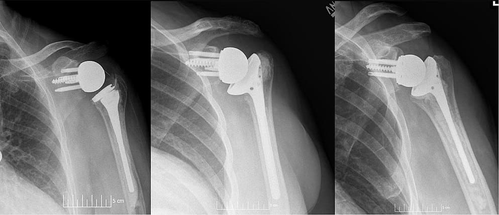 shoulder replacement surgeon in gujarat