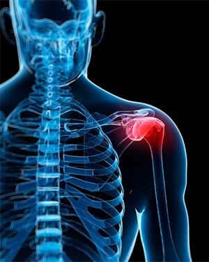 Shoulder Impingement