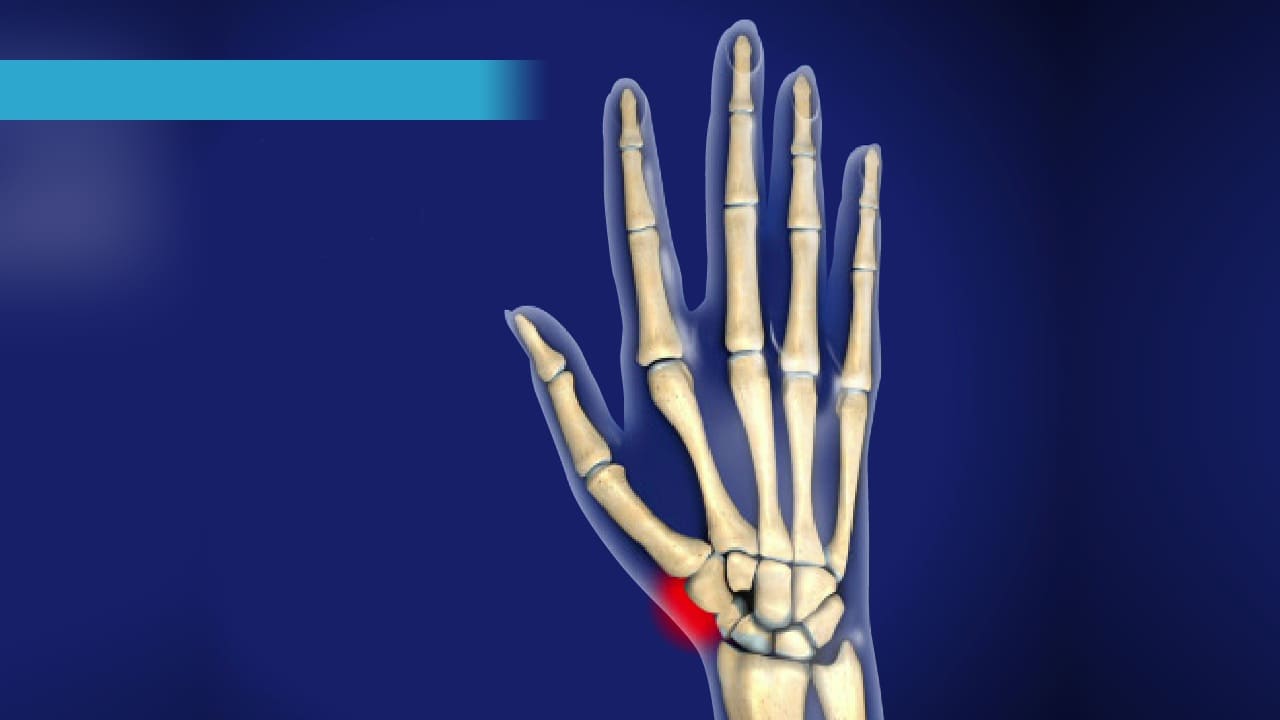 Wrist Scaphoid Fractures